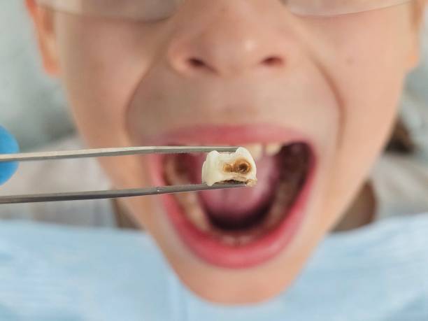 Best Emergency Root Canal Treatment in Tenaha, TX